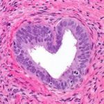 Pathology heart