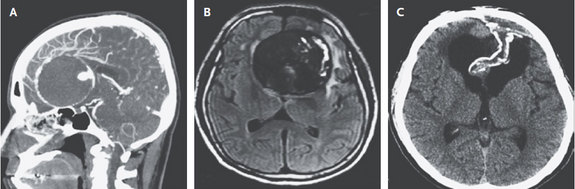 CTA (A) and MRI (B) imaging demonstrating a giant (7 cm) aneurysm in the brain of a 55 year-old Boston native who presented with 3 years of visual and cognitive decline.  CT 2 years later (C) showed complete collapse of the aneurysm sac with decreased swelling.
