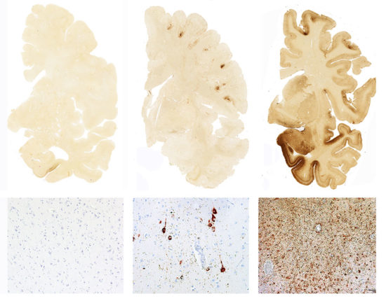 A sample of normal brain tissue (top, left), alongside samples showing mild and severe CTE. The brown stain indicates tangles of tau protein. Defective tau is associated with CTE, Alzheimer’s disease, and Parkinson’s disease. The bottom row shows microscopic images of tau, stained red, embedded in brain tissue. Photo by Ann McKee