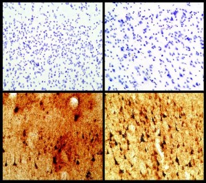 Photomicrographs of normal control brain (top panels) and the brain of Mike Borich (bottom panels), immunostained for tau protein (brown) and counterstained with cresyl violet (purple). Virtually no tau deposition is found in the normal control brain whereas numerous tau containing neurofibrillary tangles are found in individual nerve cells of the brain of Mike Borich (asterisks).