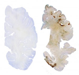 61 year old normal control (left) ; 42 year old Mike Borich (right). The normal brain shows no tau deposition, whereas the brain of Mike Borich shows extensive tau deposition throughout the frontal (1) and temporal (2) gray matter.