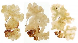 Three brain sections from Mr. Creekmur  showing dense tau deposits (brown) in the insula (1), temporal (2) and frontal (3) cortices, amygdala (4) and hippocampus (5) in the absence of beta amyloid plaques. A normal control brain would not show any brown discoloration.
