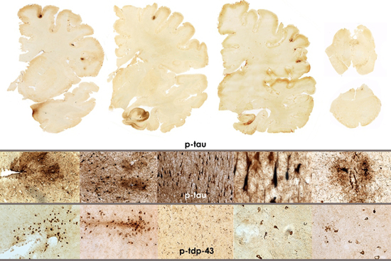 The brain of Ron Perryman shows moderate p-tau pathology involving multiple regions of brain diagnostic of stage II-III CTE. In addition, there is widespread deposition of abnormal TDP-43 protein around small blood vessels and in the cerebral cortex. These changes together with loss of anterior horn cells of the spinal cord and degeneration of the cortical spinal tracts indicate the presence of CTE plus motor neuron disease (CTE-MND). Photo by Ann C. McKee
