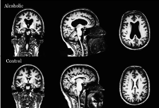 Alcoholic brain.resize Alcoholic brain.resize