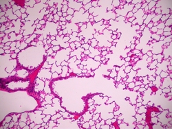 bacterial pneumonia cell