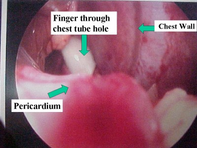 View of the thoracic cavity via a laparoscope advanced through the diaphragmatic defect