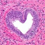 Pathology heart