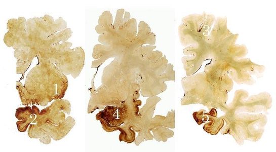 Three brain sections from Mr. Creekmur showing dense tau deposits (brown) in the insula (1), temporal (2) and frontal (3) cortices, amygdala (4) and hippocampus (5) in the absence of beta amyloid plaques. A normal control brain would not show any brown discoloration.