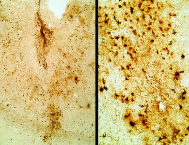 Photo on the left shows abundant tau immunoreactive neurofibrillary tangles (dark brown dots) in the cerebral cortex in a pattern unique to chronic traumatic encephalopathy (CTE). Higher magnification image on right shows a closer view of the neurofibrillary tangles in nerve cells.