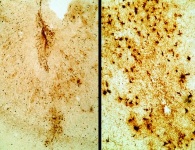 Photo on the left shows abundant tau immunoreactive neurofibrillary tangles (dark brown dots) in the cerebral cortex in a pattern unique to  chronic traumatic encephalopathy (CTE).  Higher magnification image on right shows a closer view of the neurofibrillary tangles in nerve cells.