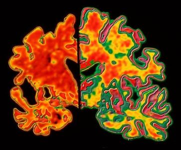 M108/0332 Alzheimer's brain left. Normal brain right.