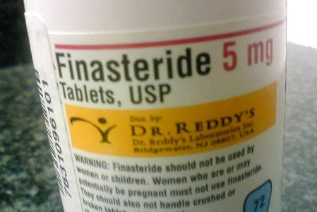 BU Today Hair replacement finasteride_h_0 Photocaption Finasteride, a popular baldness treatment, can also cause sex problems. Photo by Derek Rose