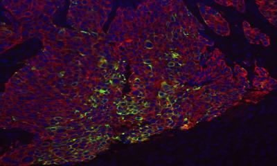 Basal-like breast cancer. Courtesy of UNC/Perou Lab
