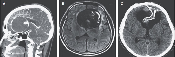 CTA (A) and MRI (B) imaging demonstrating a giant (7 cm) aneurysm in the brain of a 55 year-old Boston native who presented with 3 years of visual and cognitive decline. CT 2 years later (C) showed complete collapse of the aneurysm sac with decreased swelling.