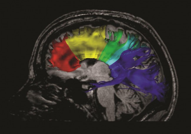 Tractography of the corpus callosum. The corpus callosum was subdivided into five regions containing commissural fibers of prefrontal (region I), premotor and supplementary motor (region II), primary motor (region III), sensory (region IV), and parietal, temporal and occipital cortical areas (region V). 70 Tracts were obtained using deterministic (streamline) tractography to trace fiber paths through the regions of interest