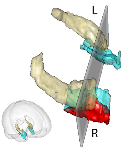An analysis technique called voxel-based morphometry reveals the anatomy of specific brain regions, such as the hippocampus (gold) and entorhinal cortex (blue), from functional magnetic imaging data. Schon’s lab found that higher levels of fitness correlated with increased entorhinal cortex volume on the right side (red). An ongoing exercise intervention study will help determine whether the brain region grows as fitness improves. Image courtesy of Schon