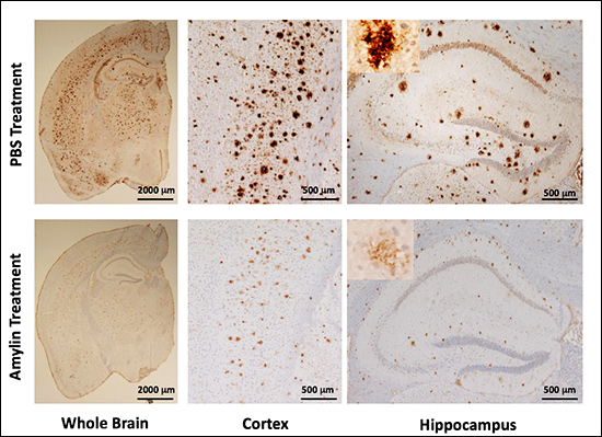 The brains of mice bred to develop Alzheimer’s. The mice who received saline injections (top) developed amyloid plaques, a hallmark of Alzheimer’s disease, seen here as brown spots. Mice who were given amylin injections (bottom) had far few fewer plaques, and also scored better on learning and memory tests. Photo courtesy of Wendy Qiu