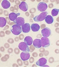 COM Acute_leukemia-ALL