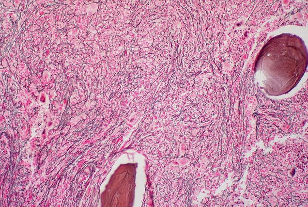 myelofibrosis_sample