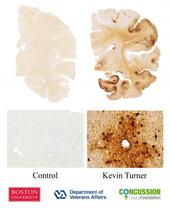 Photo credit: Ann McKee, MD, VA Boston Healthcare System/Boston University School of Medicine Image 1: Top panel: Whole mount hemi-sections of the brain of a 60 year old control subject (left) and of Kevin Turner (right) immunostained for phosphorylated tau (p-tau) protein (brown areas). The control brain shows no p-tau deposition, whereas the brain of Kevin Turner shows dense p-tau deposits throughout the frontal and temporal lobes. Lower panel: Photomicrographs of normal control brain (left) showing no immunostaining for p-tau protein (left). In contrast, the brain of Kevin Turner (right) shows the defining pathology of CTE: p-tau in neurofibrillary tangles around a small blood vessel. 