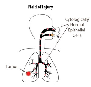 Lung cancer’s “field of injury” extends well beyond the tumor. New work by Avrum Spira and colleagues demonstrates genetic changes in nasal cells of patients who went on to develop lung cancer. Courtesy of Avrum Spira