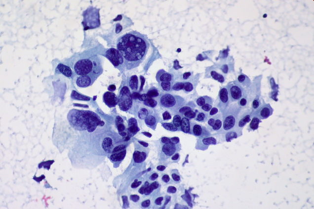 COM Non-small_Cell_Carcinoma_of_the_Lung,_FNA_(5715460701)