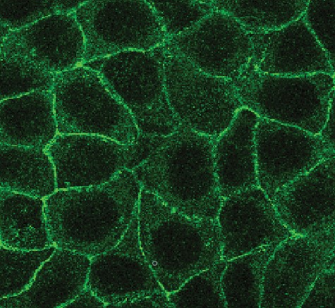 Epithelial breast cancer cells exhibit tight junctions enriched in the protein E-cadherin (staining). Cancer cells undergoing epithelial-to-mesenchymal transition (EMT) lose their cuboidal shape and tight junctions, characteristics of their epithelial nature, to acquire a plastic mesenchymal phenotype and disseminate.