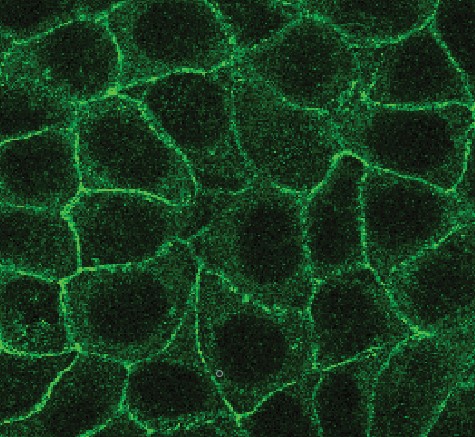 Epithelial breast cancer cells exhibit tight junctions enriched in the protein E-cadherin (staining). Cancer cells undergoing epithelial-to-mesenchymal transition (EMT) lose their cuboidal shape and tight junctions, characteristics of their epithelial nature, to acquire a plastic mesenchymal phenotype and disseminate. 