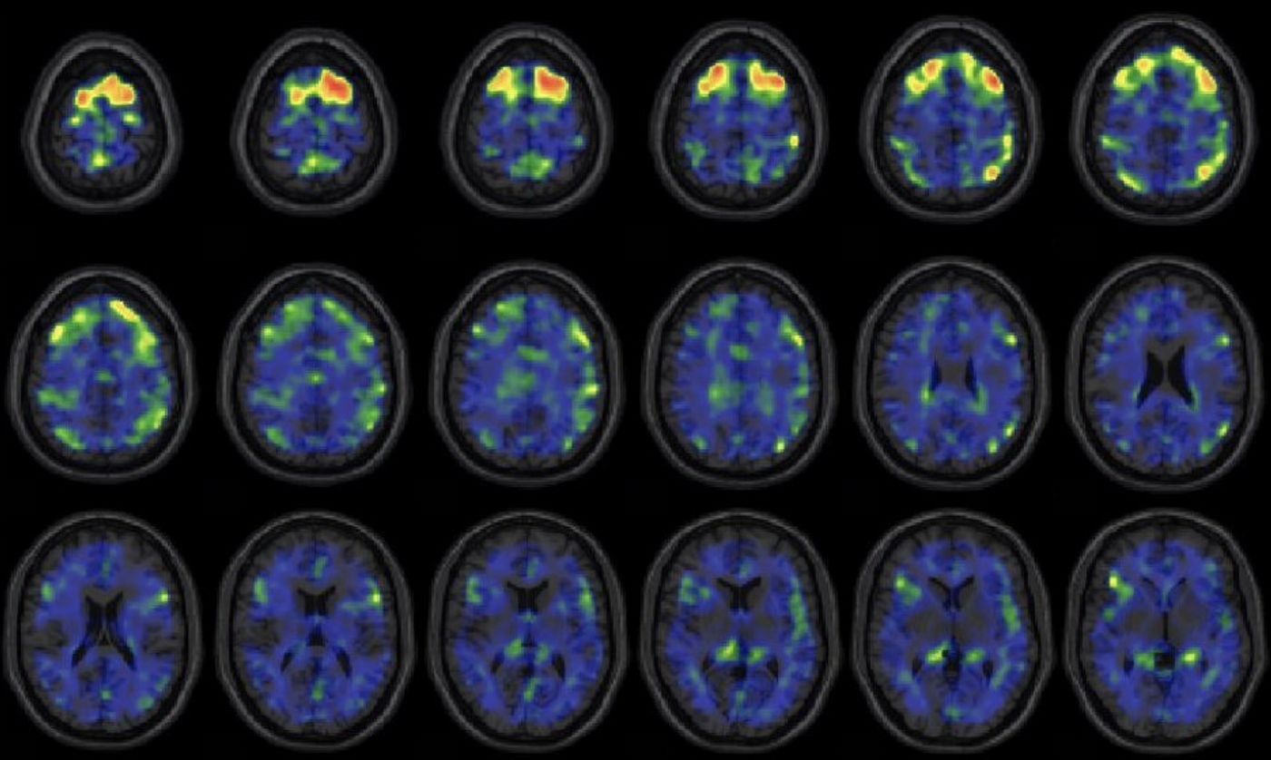 brain scan on computer screen