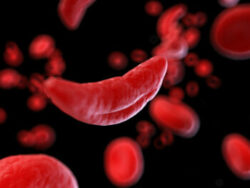 Sickle Cell