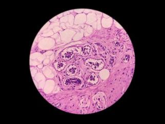 round microscopic image of pink melanoma cells