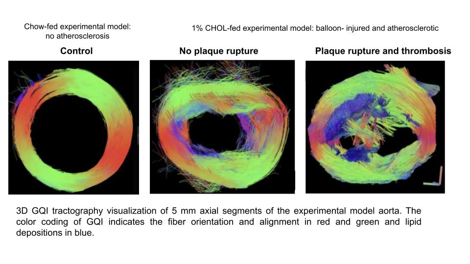 3D GQI tractography visualization of 5 mm axial segments of the experimental model aorta. The color coding of GQI indicates the fiber orientation and alignment in red and green and lipid depositions in blue. Three images of experimental model showing control, no plaque rupture, and thrombosis..