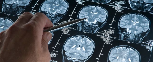 A doctors hand examines x-ray evidence of brain tissue.