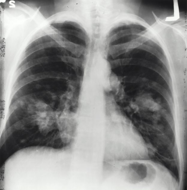 x-ray image of a chest. Both sides of the lungs are visible with a growth on the left side of the lung, which could possibly be lung cancer.