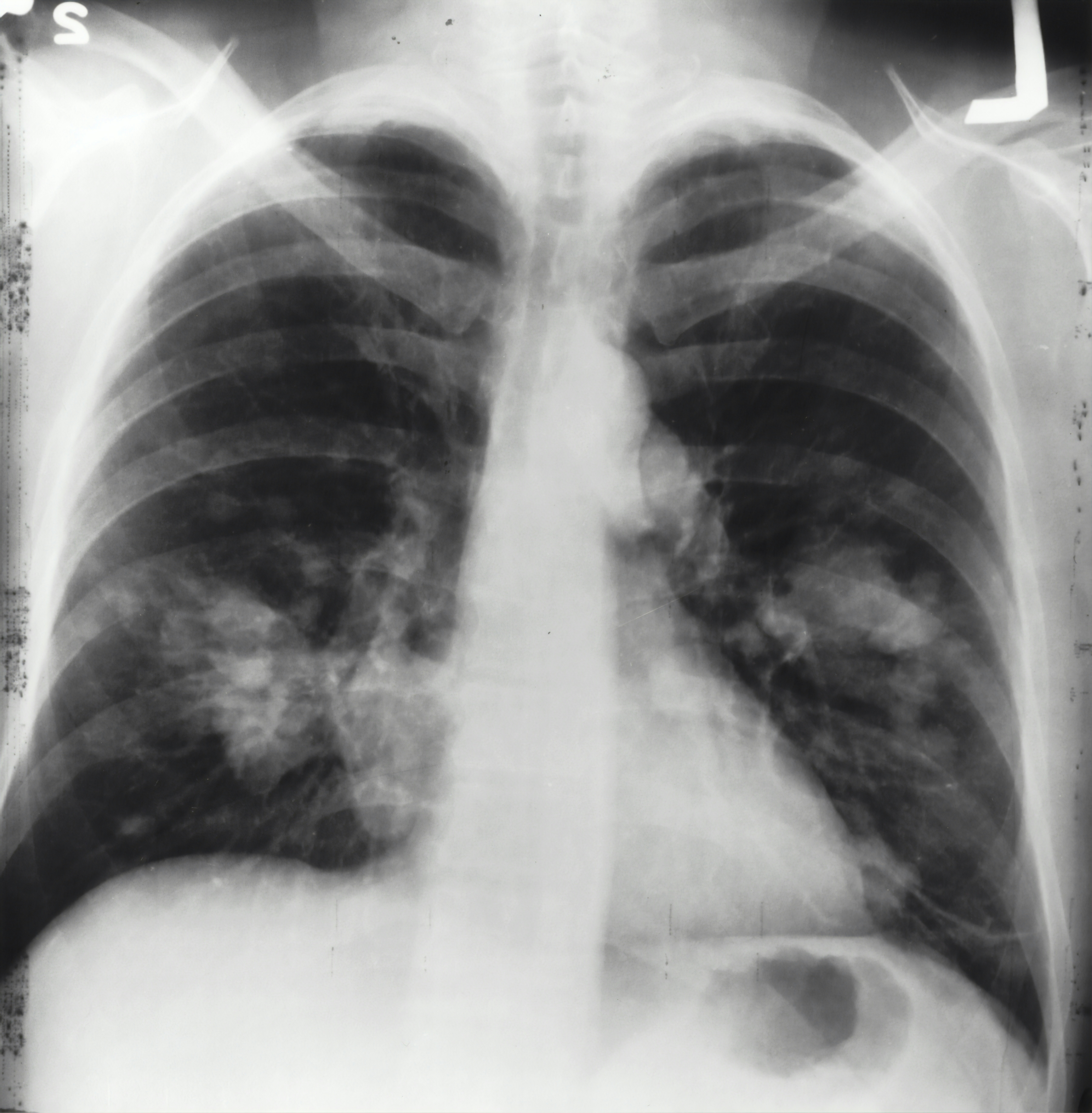 x-ray image of a chest. Both sides of the lungs are visible with a growth on the left side of the lung, which could possibly be lung cancer.