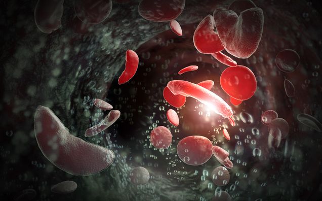 Illustration of sickle cells in the blood stream