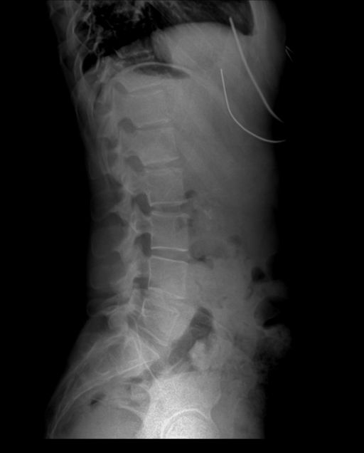 Xray of spine