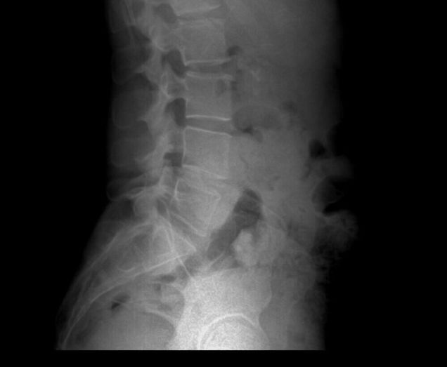 xray of spine