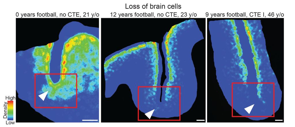 Visual Depiction of neuron loss over different ages