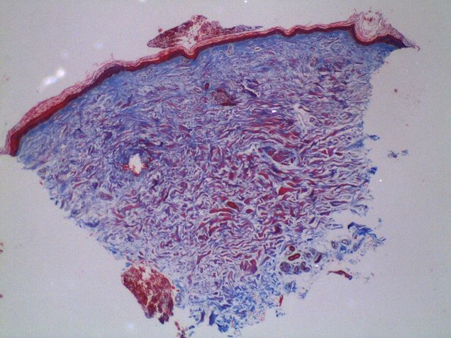 Close up of skin biopsy stained bluish