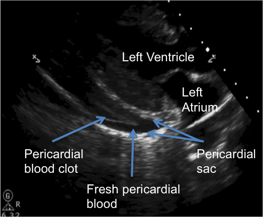 North American Rescue - #EFAST with @nardoctor Let's review the E-FAST  exam. This quick ultrasound exam allows us to evaluate for intrabdominal  hemorrhage, cardiac tamponade, hemothorax and pneumothorax. The chart above  from @