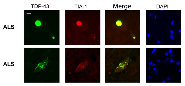 TDP43 ALS (2)